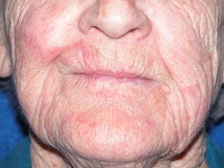 Painful perioral rash with unpredictable flare-ups Painful perioral rash with unpredictable flare-ups